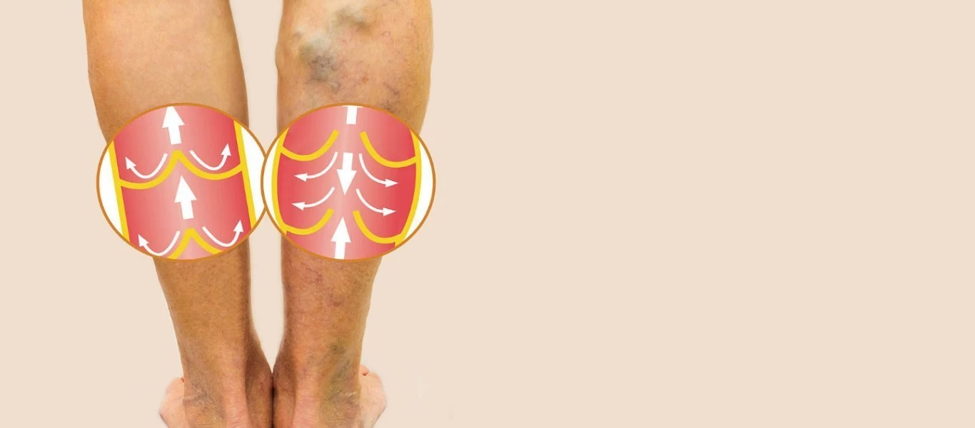 Ποιοι κινδυνεύουν περισσότερο από φλεβική θρόμβωση; - Τα συμπτώματα